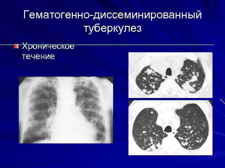 Укажите при туберкулезе какой локализации схема лечения выглядит следующим образом 5hrze 7 10hr