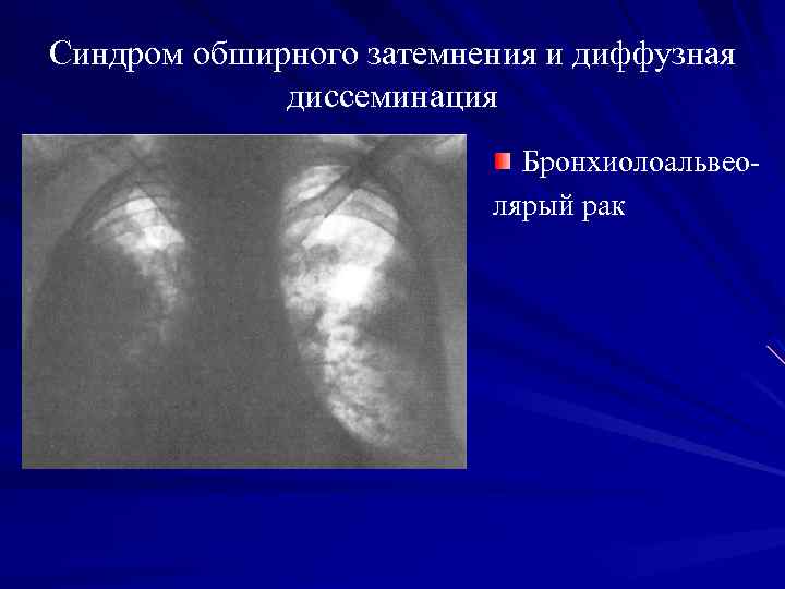 Синдром обширного затемнения и диффузная диссеминация Бронхиолоальвеолярый рак 