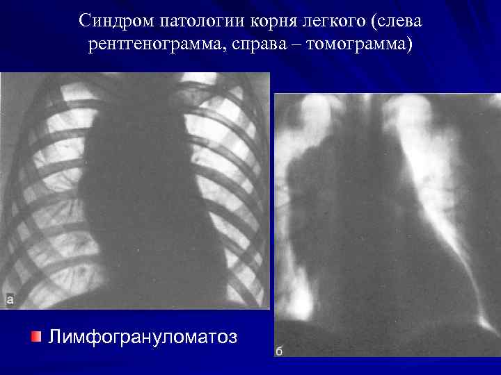 Синдром патологии корня легкого (слева рентгенограмма, справа – томограмма) Лимфогрануломатоз 