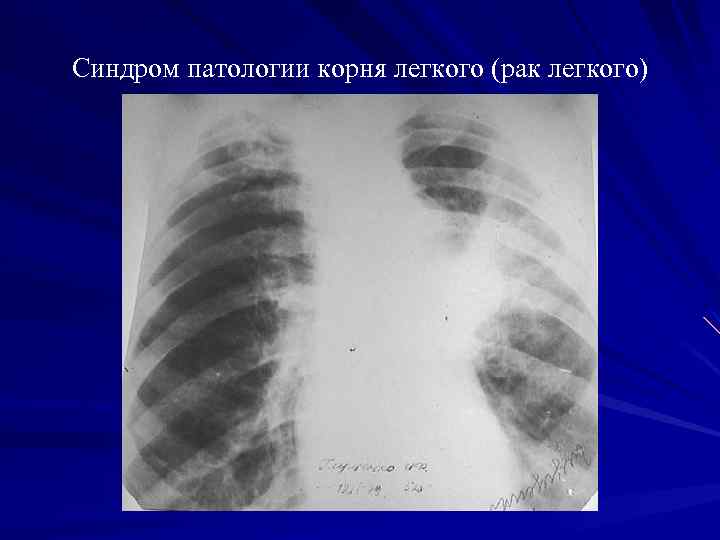 Синдром патологии корня легкого (рак легкого) 