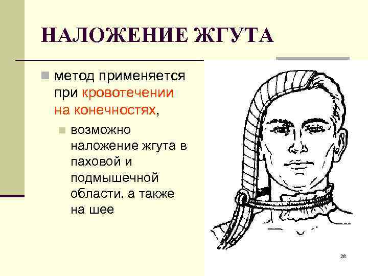 НАЛОЖЕНИЕ ЖГУТА n метод применяется при кровотечении на конечностях, n возможно наложение жгута в