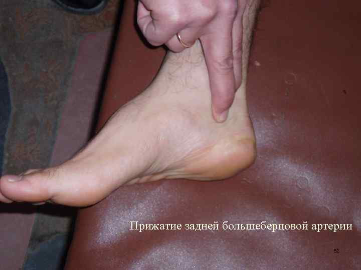 Прижатие задней большеберцовой артерии 52 