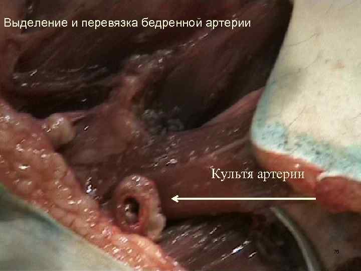 Выделение и перевязка бедренной артерии Культя артерии 76 