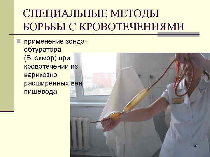 СПЕЦИАЛЬНЫЕ МЕТОДЫ БОРЬБЫ С КРОВОТЕЧЕНИЯМИ n применение зонда- обтуратора (Блэкмор) при кровотечении из варикозно