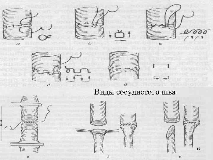 Виды сосудистого шва 85 