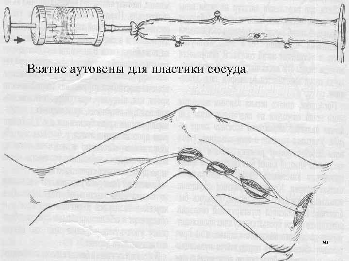 Взятие аутовены для пластики сосуда 86 