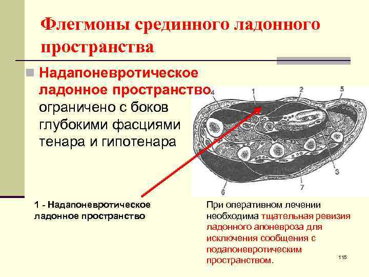 Флегмоны срединного ладонного пространства n Надапоневротическое ладонное пространство ограничено с боков глубокими фасциями тенара