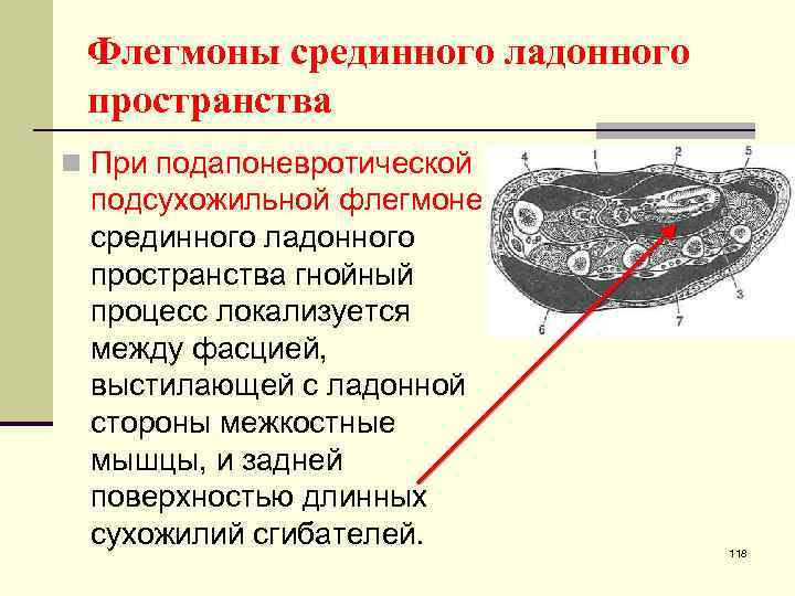 Флегмоны срединного ладонного пространства n При подапоневротической подсухожильной флегмоне срединного ладонного пространства гнойный процесс