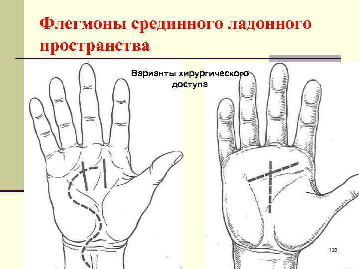 Флегмоны срединного ладонного пространства Варианты хирургического доступа 123 