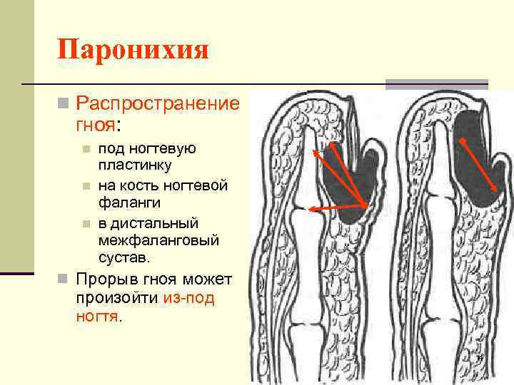 Паронихия на ноге фото