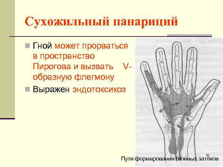 Сухожильный панариций n Гной может прорваться в пространство Пирогова и вызвать Vобразную флегмону n