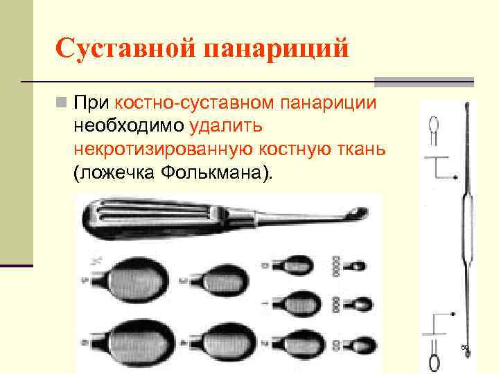 Хирургическая ложка фолькмана рисунок