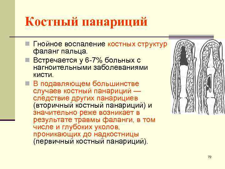 Костный панариций n Гнойное воспаление костных структур фаланг пальца. n Встречается у 6 -7%