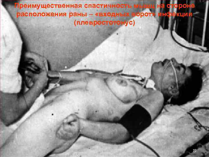 Преимущественная спастичность мышц на стороне расположения раны – «входных ворот» инфекции (плевростотонус) 19 