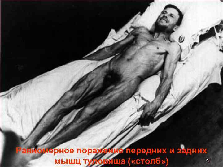 Равномерное поражение передних и задних 20 мышц туловища ( «столб» ) 