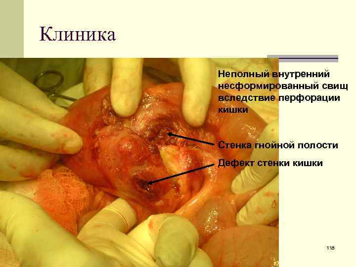 Клиника Неполный внутренний несформированный свищ вследствие перфорации кишки Стенка гнойной полости Дефект стенки кишки