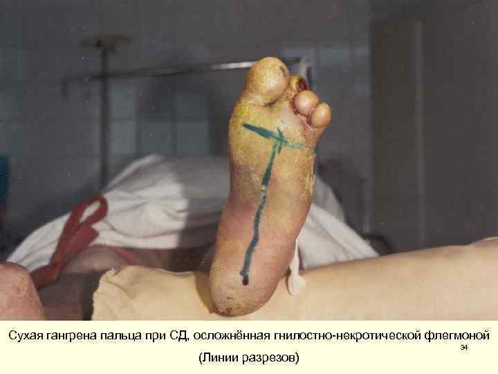 Сухая гангрена пальца при СД, осложнённая гнилостно-некротической флегмоной 34 (Линии разрезов) 
