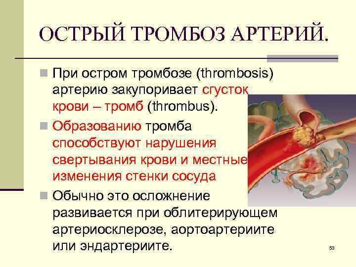 ОСТРЫЙ ТРОМБОЗ АРТЕРИЙ. n При остромбозе (thrombosis) артерию закупоривает сгусток крови – тромб (thrombus).
