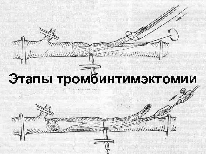 Этапы тромбинтимэктомии 60 