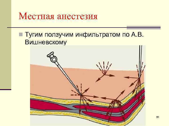 Местное обезболивание