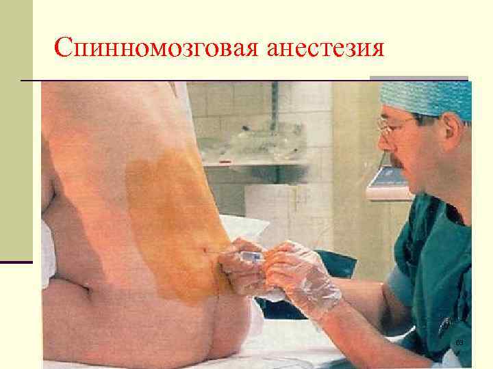 Спинномозговая анестезия 63 