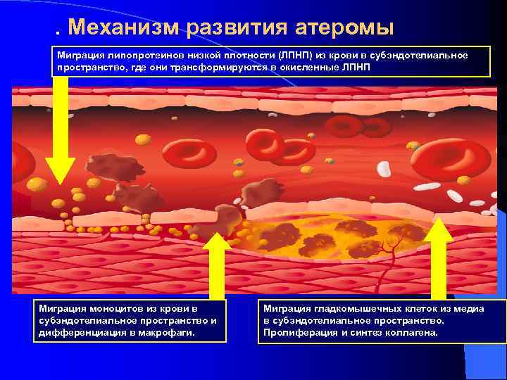 . Механизм развития атеромы Миграция липопротеинов низкой плотности (ЛПНП) из крови в субэндотелиальное пространство,