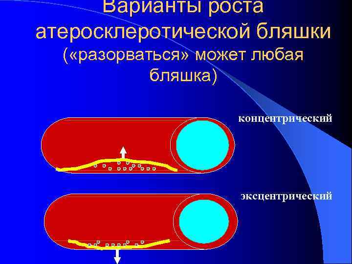 Варианты роста атеросклеротической бляшки ( «разорваться» может любая бляшка) концентрический эксцентрический 