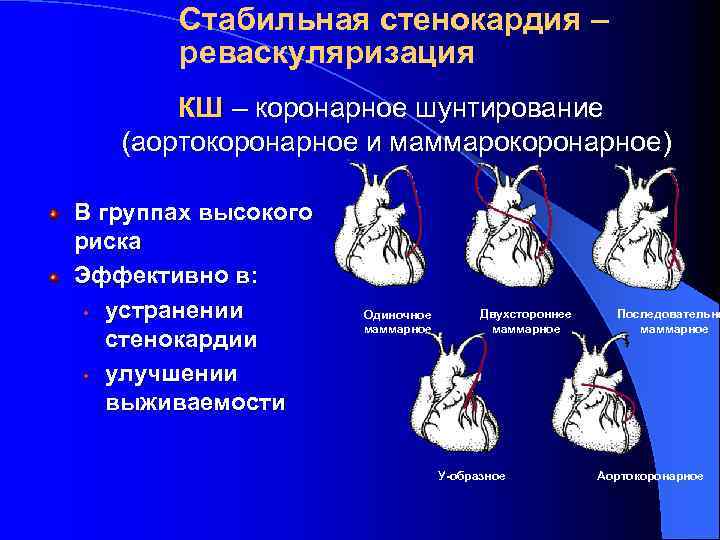 Стабильная стенокардия – реваскуляризация КШ – коронарное шунтирование (аортокоронарное и маммарокоронарное) В группах высокого