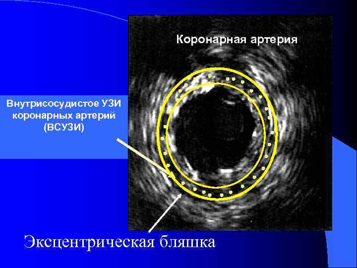 Коронарная артерия Внутрисосудистое УЗИ коронарных артерий (ВСУЗИ) Эксцентрическая бляшка 