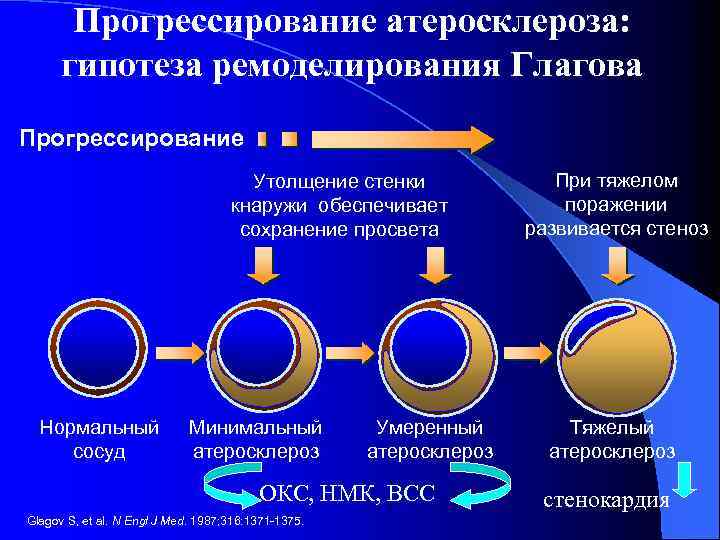 Прогрессирование атеросклероза: гипотеза ремоделирования Глагова Прогрессирование Утолщение стенки кнаружи обеспечивает сохранение просвета Нормальный сосуд
