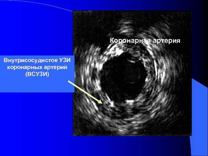 Коронарная артерия Внутрисосудистое УЗИ коронарных артерий (ВСУЗИ) 