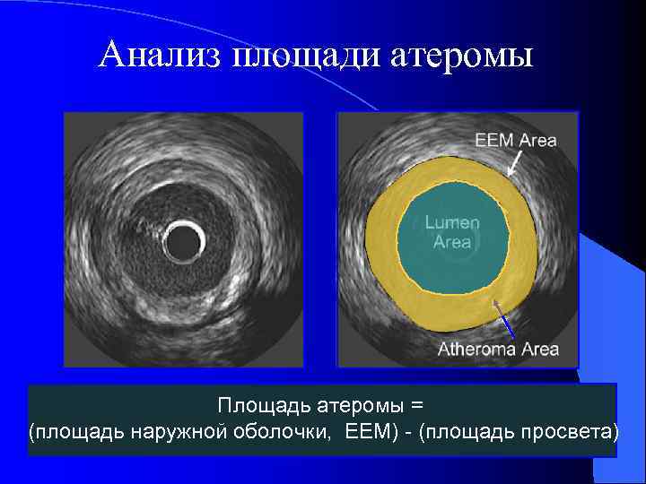 Анализ площади атеромы Площадь атеромы = (площадь наружной оболочки, ЕЕМ) - (площадь просвета) 