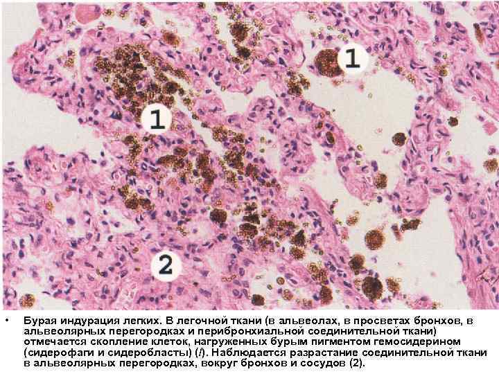  • Бурая индурация легких. В легочной ткани (в альвеолах, в просветах бронхов, в
