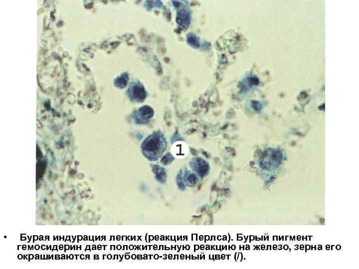  • Бурая индурация легких (реакция Перлса). Бурый пигмент гемосидерин дает положительную реакцию на