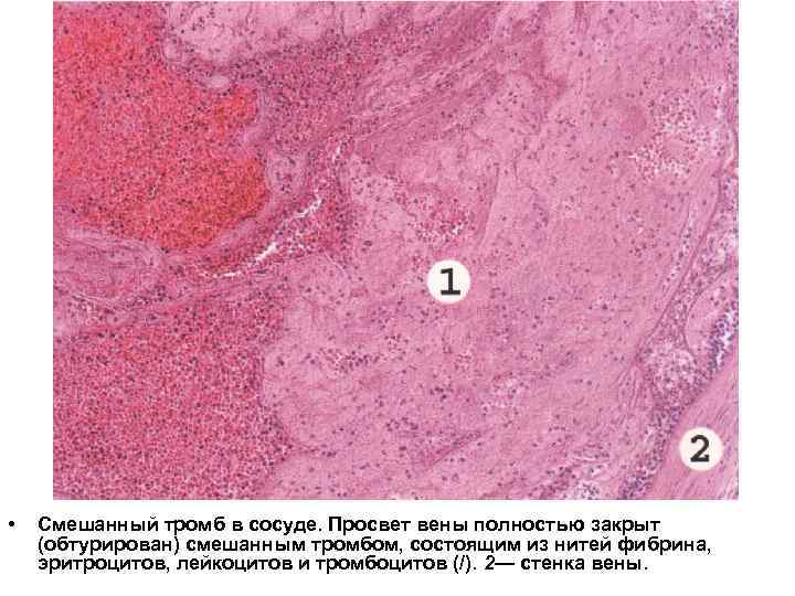  • Смешанный тромб в сосуде. Просвет вены полностью закрыт (обтурирован) смешанным тромбом, состоящим