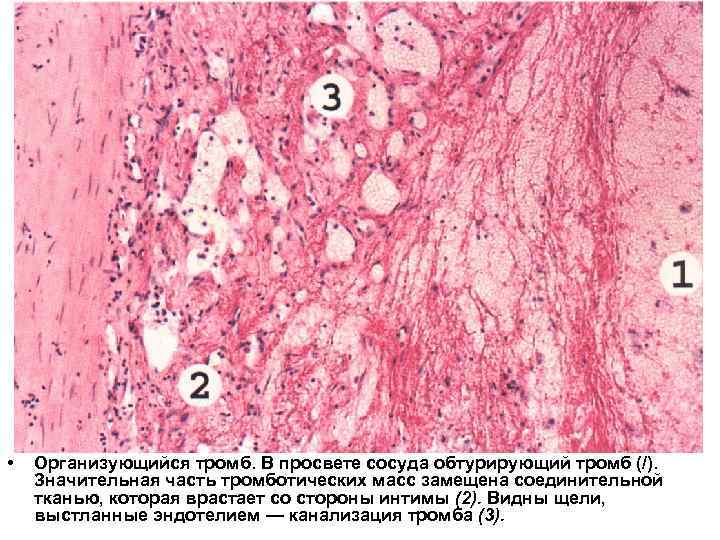  • Организующийся тромб. В просвете сосуда обтурирующий тромб (/). Значительная часть тромботических масс