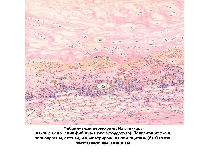 Фибринозный перикардит. На эпикарде рыхлые наложения фибринозного экссудата (а). Подлежащие ткани полнокровны, отечны, инфильтрированы