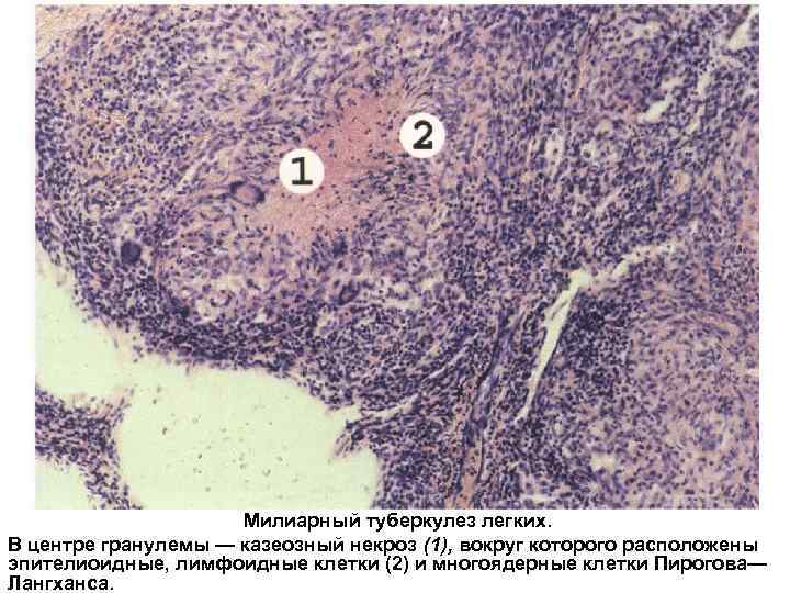 Милиарный туберкулез легких. В центре гранулемы — казеозный некроз (1), вокруг которого расположены эпителиоидные,