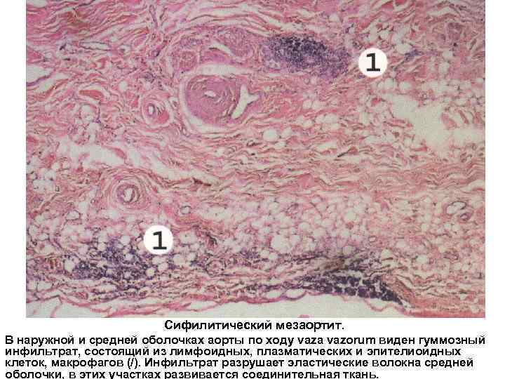 Сифилитический мезаортит. В наружной и средней оболочках аорты по ходу vaza vazorum виден гуммозный