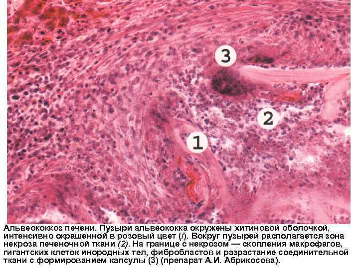 Альвеококкоз печени. Пузыри альвеококка окружены хитиновой оболочкой, интенсивно окрашенной в розовый цвет (/). Вокруг