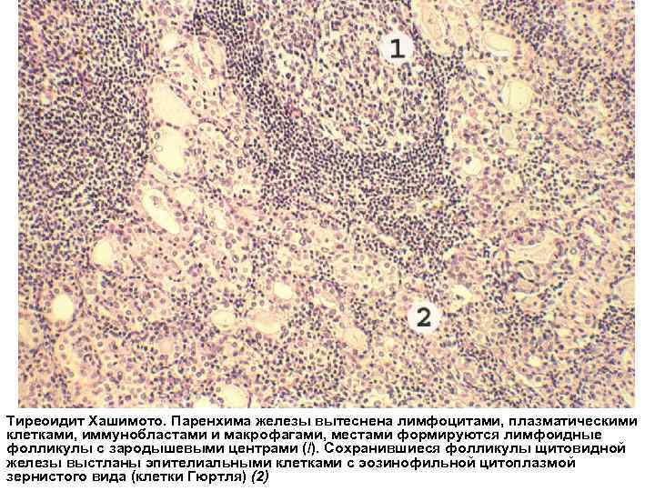 Тиреоидит Хашимото. Паренхима железы вытеснена лимфоцитами, плазматическими клетками, иммунобластами и макрофагами, местами формируются лимфоидные