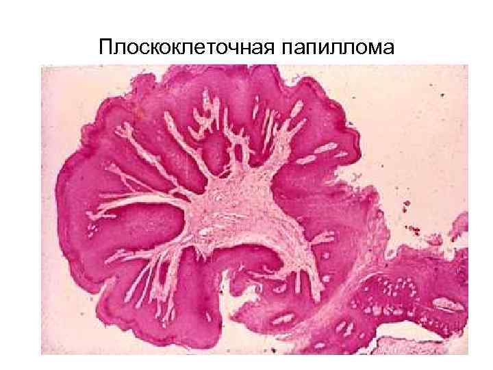 Плоскоклеточная папиллома 