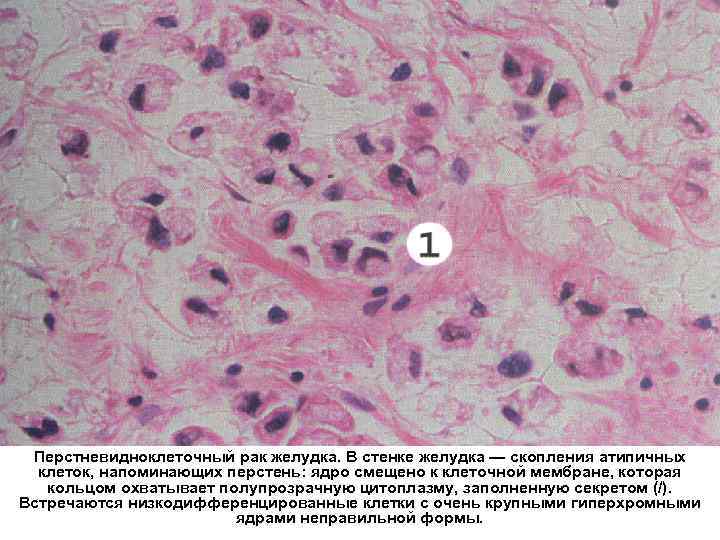 Перстневидноклеточный рак желудка. В стенке желудка — скопления атипичных клеток, напоминающих перстень: ядро смещено