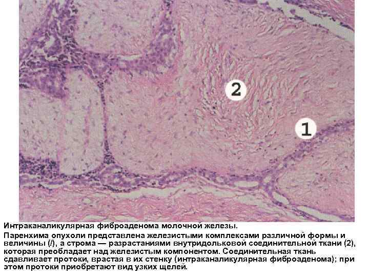 Интраканаликулярная фиброаденома молочной железы. Паренхима опухоли представлена железистыми комплексами различной формы и величины (/),