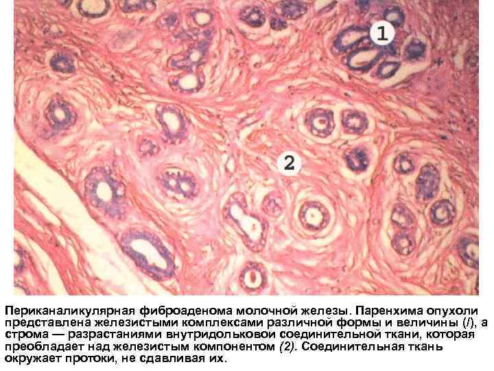 Периканаликулярная фиброаденома молочной железы. Паренхима опухоли представлена железистыми комплексами различной формы и величины (/),