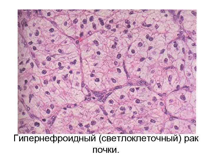 Гипернефроидный (светлоклеточный) рак почки. 