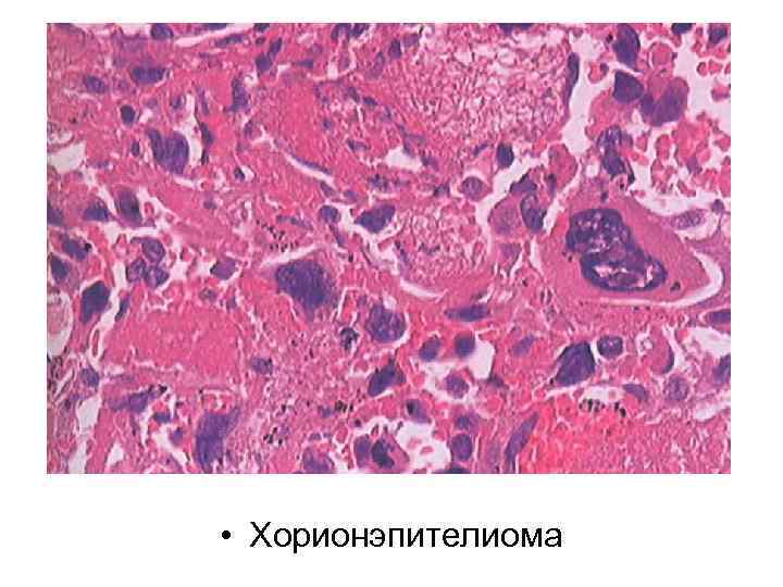  • Хорионэпителиома 