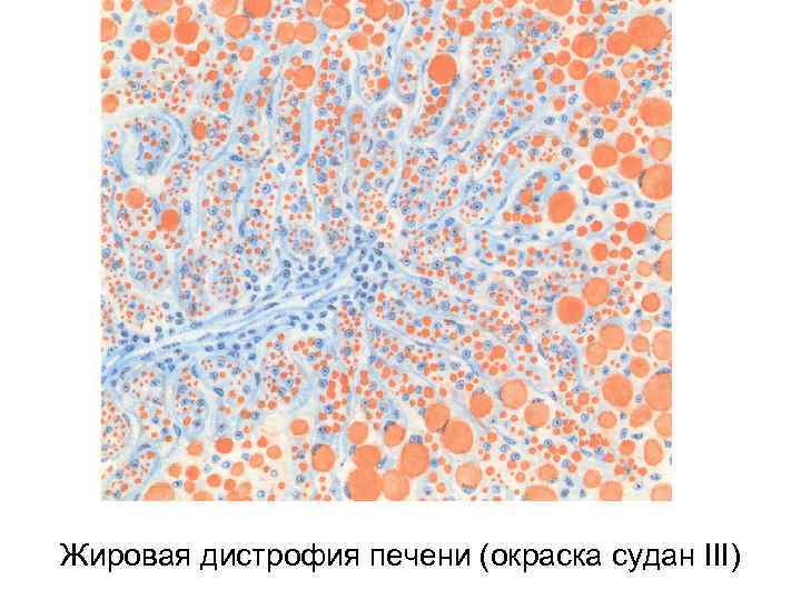 Жировая дистрофия печени (окраска судан III) 