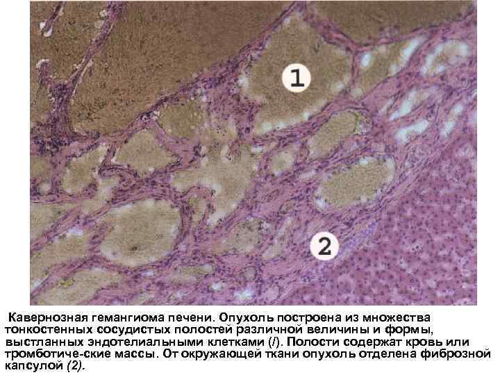 Кавернозная гемангиома печени. Опухоль построена из множества тонкостенных сосудистых полостей различной величины и формы,