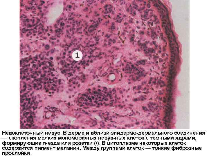 Невоклеточный невус. В дерме и вблизи эпидермо-дермального соединения — скопления мелких мономорфных невус-ных клеток